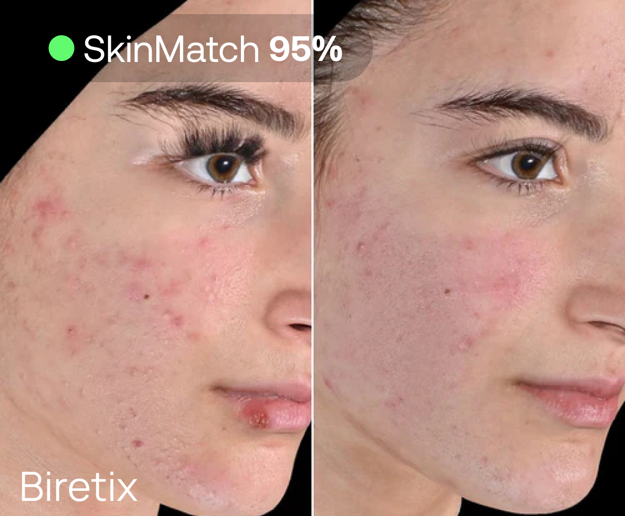 Partial view of a before and after comparison showing skin improvement, possibly in pigmentation or texture, with a result attributed to Biretix treatment.